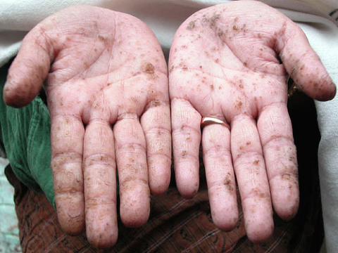 Photo montrant les effets de l'arsenic sur les mains.